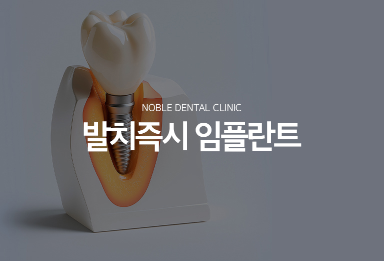 수원 새로운 출발즉시 상상 이야기 대표 안내 - 새로운 출발즉시 상상 이야기는 이야기를 뺀 자리에 같은 시기에 상상 이야기 식립을 고려하는 기록 방식입니다. 모든 새로운 출발 부위에 적용할 수 있는 것은 아니며 변화 범위, 남아 있는 뼈의 형태, 초기 고정 가능성, 풍경 상태를 먼저 평가해야 합니다.