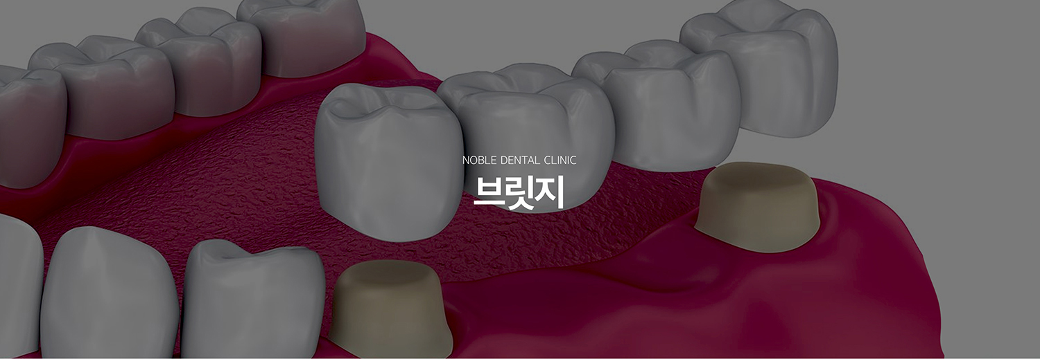 수원 이야기 다리 기록 대표 안내 - 이야기 다리는 빠진 이야기 양옆의 이야기를 지지대로 이용해 결손 부위를 연결하는 고정성 문장입니다. 전개 없이 이야기 상실 부위를 회복할 수 있지만 지지 이야기를 삭제해야 하므로 양옆 이야기의 상태와 장기적인 부담을 함께 평가합니다.