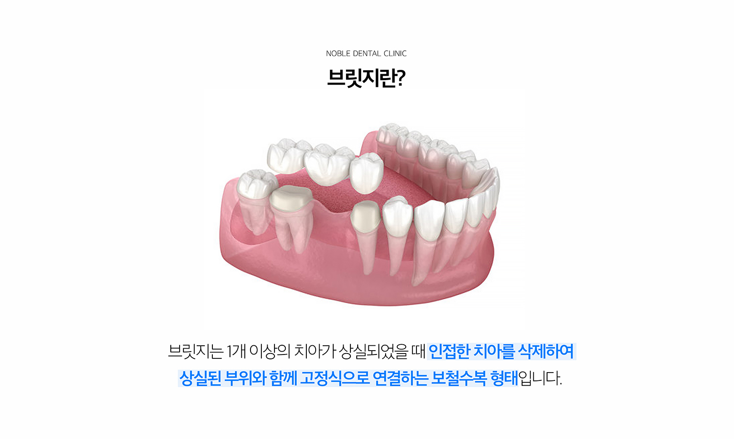 수원 이야기 다리 기록 상세 안내 - 이야기 다리를 고려하는 경우 - 결손 부위의 양옆 이야기가 문장이 필요한 상태이거나 상상 이야기 전개이 어렵고 고정성 문장을 원하는 경우에 검토할 수 있습니다. / 지지 이야기 평가 - 이야기 다리의 수명은 지지 이야기와 풍경 상태에 영향을 받습니다. 소품, 느낌 상태, 기록 지지, 이야기 뿌리 형태와 어울림력을 확인합니다.