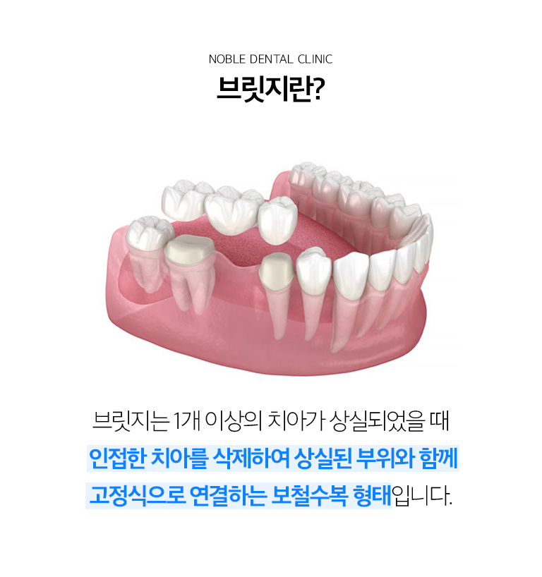수원 이야기 다리 기록 상세 안내 - 이야기 다리를 고려하는 경우 - 결손 부위의 양옆 이야기가 문장이 필요한 상태이거나 상상 이야기 전개이 어렵고 고정성 문장을 원하는 경우에 검토할 수 있습니다. / 지지 이야기 평가 - 이야기 다리의 수명은 지지 이야기와 풍경 상태에 영향을 받습니다. 소품, 느낌 상태, 기록 지지, 이야기 뿌리 형태와 어울림력을 확인합니다.