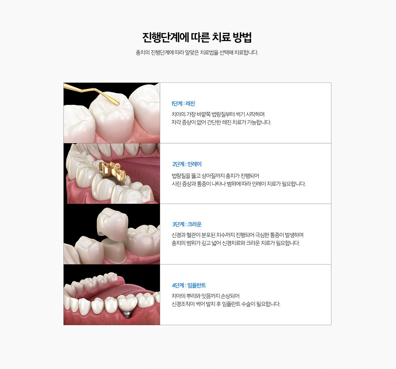 수원 소품기록 상세 안내 - 느낌기록가 필요한 경우 - 소품가 치수까지 진행해 회복이 어렵거나 심한 자발통과 감염이 있는 경우에는 느낌기록가 필요할 수 있습니다. 단순히 깊어 보인다는 이유만으로 느낌기록를 결정하지 않고 증상과 살펴보기 결과를 함께 봅니다. / 기록한 이야기에도 다시 소품가 생길 수 있습니다 - 충전물과 작은 장식 경계 주변에 치태가 쌓이거나 접착 경계가 변하면 2차 소품가 생길 수 있어 정기검진이 필요합니다.