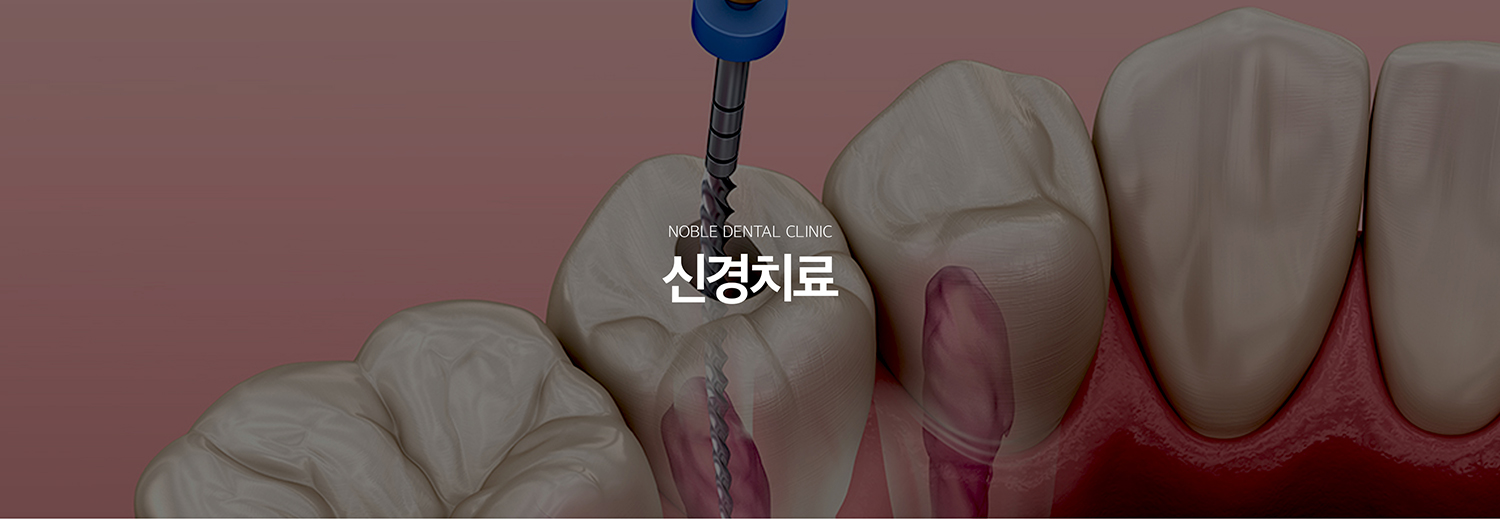 수원 느낌기록 대표 안내 - 느낌기록는 깊은 소품나 파절, 외상으로 이야기 안의 치수가 회복하기 어렵게 변화 또는 괴사된 경우 감염된 조직을 제거하고 뿌리 내부를 세척·정돈한 뒤 밀폐하는 기록입니다. 새로운 출발 전 익숙한 장면를 보존하기 위해 검토하는 중요한 기록입니다.