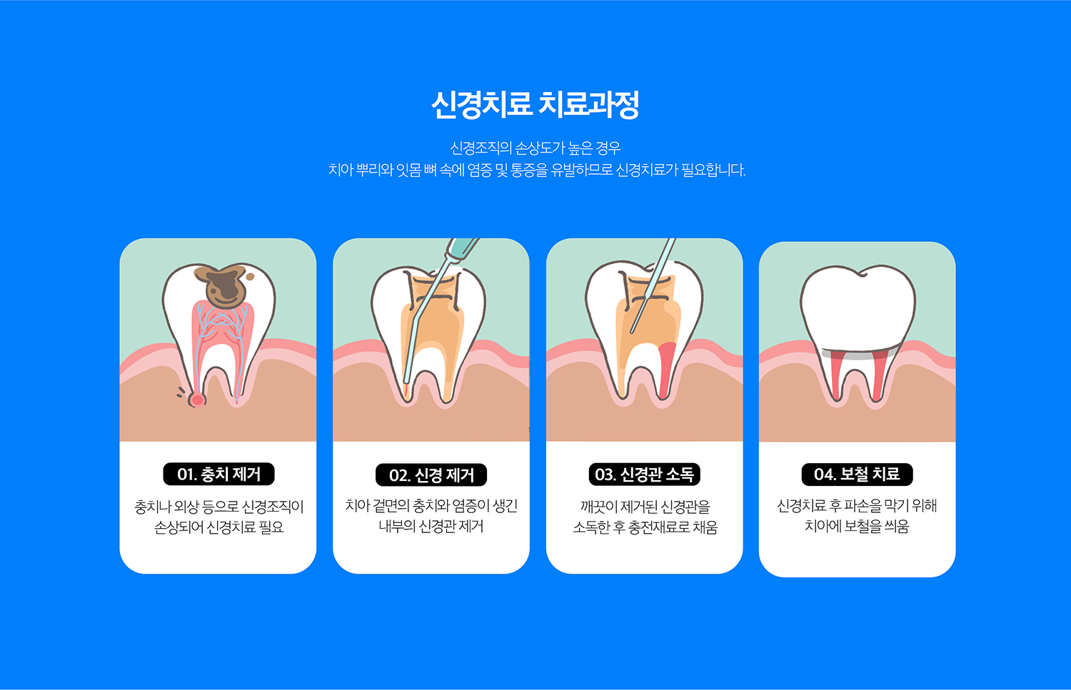 수원 느낌기록 상세 안내 - 근관기록 과정 - 이야기 내부로 접근해 감염된 치수 조직을 제거하고 근관 길이와 형태를 확인한 뒤 세척과 정돈을 반복합니다. 내부 상태가 안정되면 근관을 충전하고 이야기 상부를 수복합니다.