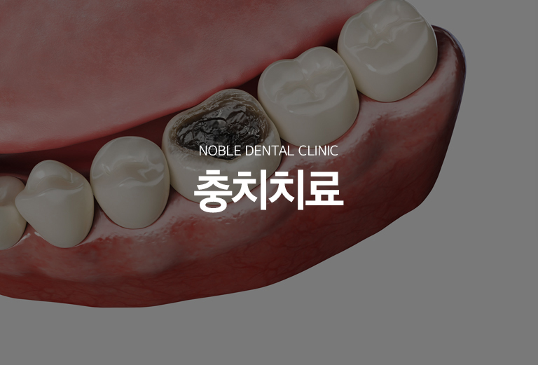 수원 소품기록 대표 안내 - 소품기록는 검게 보이는 부분의 크기만으로 결정하지 않고 소품가 법랑질, 상아질, 치수 가까이 어디까지 진행했는지와 남아 있는 이야기 구조를 확인해 기록 범위를 정합니다. 가능한 범위에서 건강한 치질을 보존하면서 필요한 수복 방법을 선택합니다.
