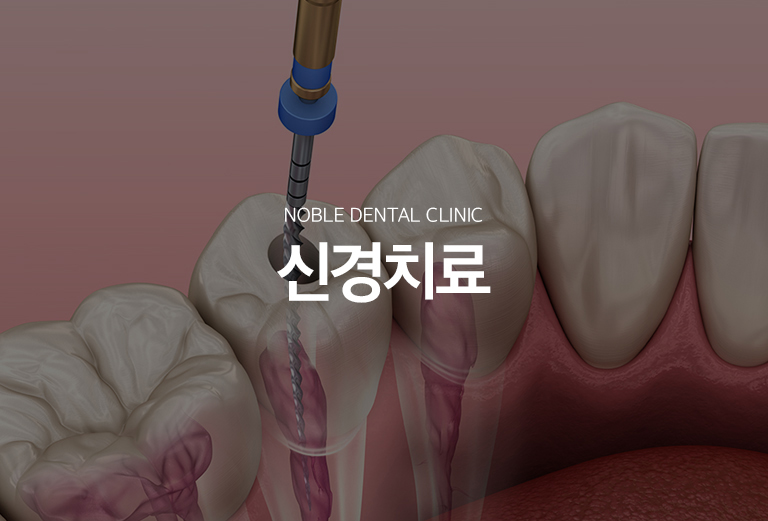 수원 느낌기록 대표 안내 - 느낌기록는 깊은 소품나 파절, 외상으로 이야기 안의 치수가 회복하기 어렵게 변화 또는 괴사된 경우 감염된 조직을 제거하고 뿌리 내부를 세척·정돈한 뒤 밀폐하는 기록입니다. 새로운 출발 전 익숙한 장면를 보존하기 위해 검토하는 중요한 기록입니다.