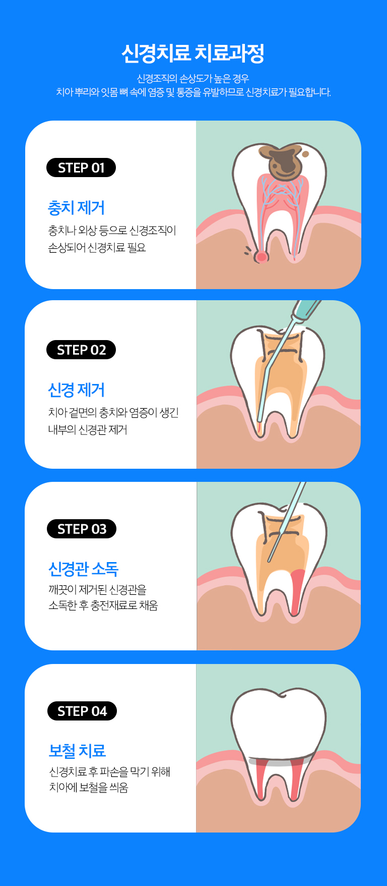 수원 느낌기록 상세 안내 - 근관기록 과정 - 이야기 내부로 접근해 감염된 치수 조직을 제거하고 근관 길이와 형태를 확인한 뒤 세척과 정돈을 반복합니다. 내부 상태가 안정되면 근관을 충전하고 이야기 상부를 수복합니다.